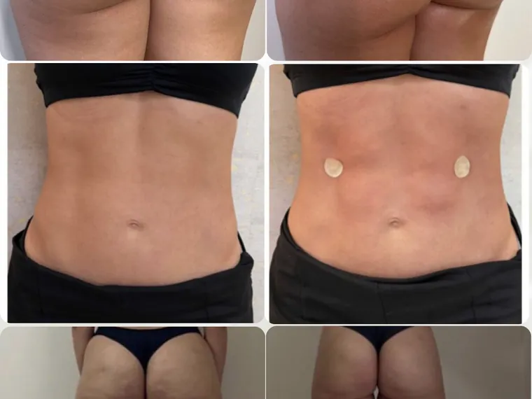 Antes e depois de protocolo corporal integrado, em várias áreas