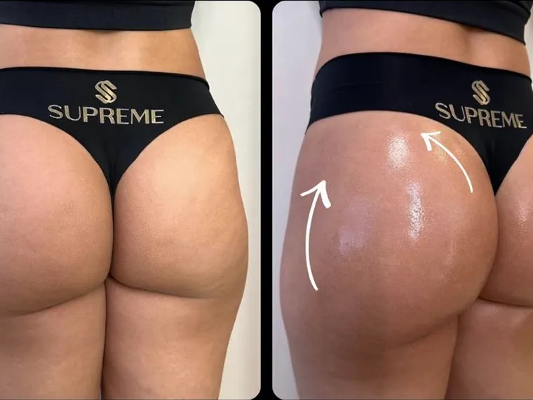 Antes e depois do protocolo Glúteo Supreme